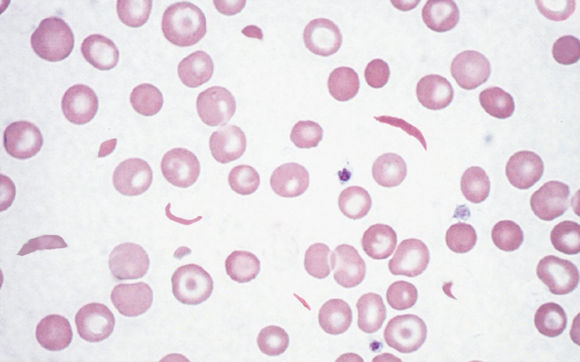 Sickle Cell Anemia Images  Browse 25460 Stock Photos Vectors and Video   Adobe Stock